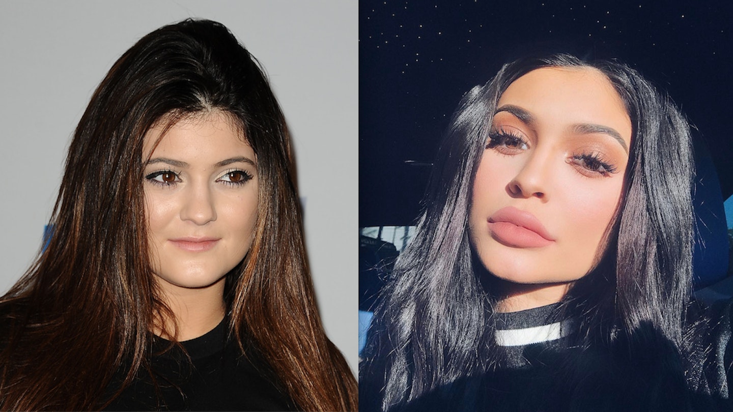 kylie jenner before and after lips