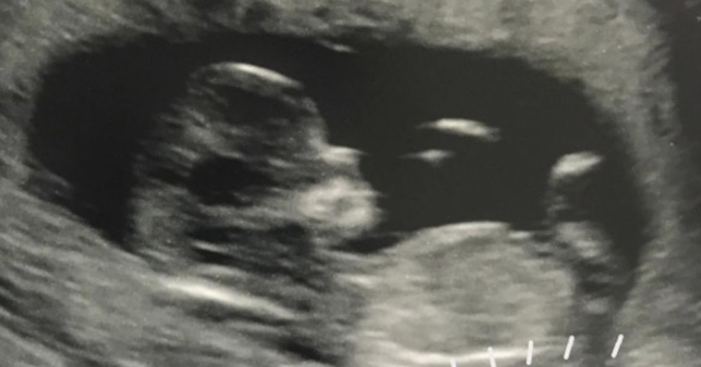 Laura Carter baby scan