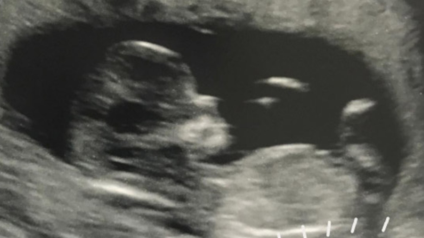 Laura Carter baby scan