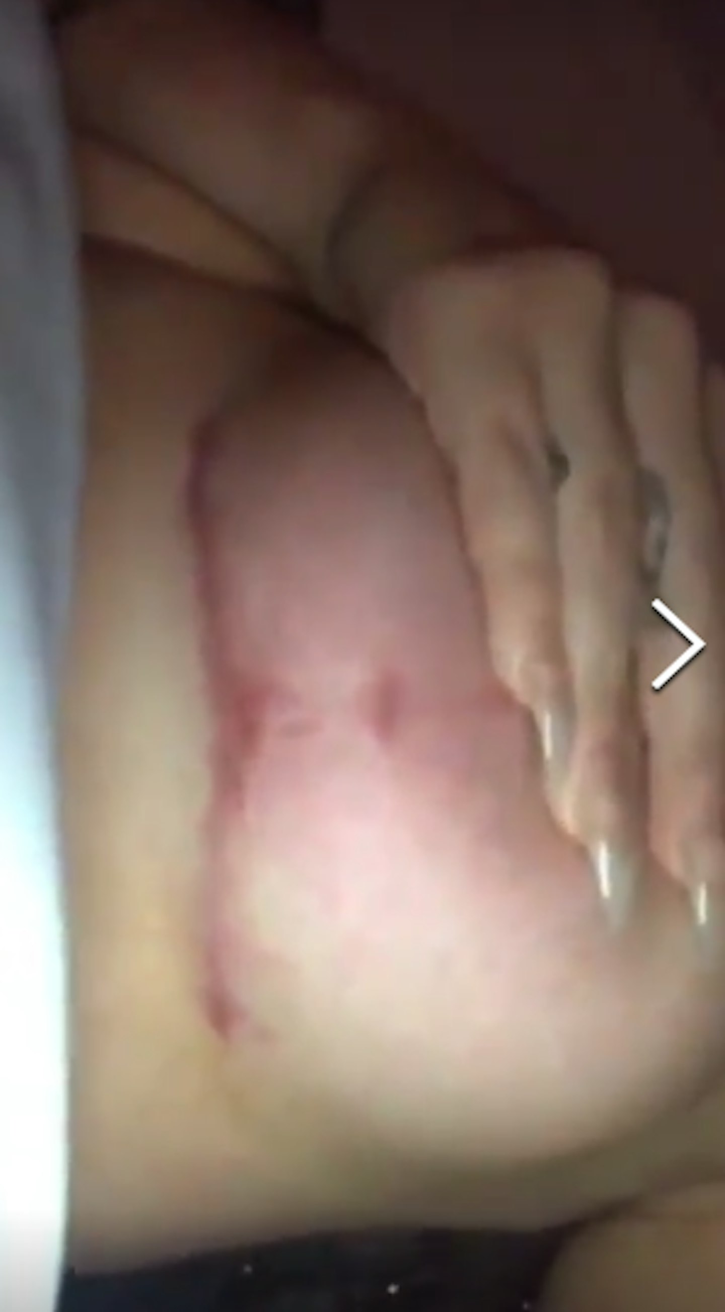 Chloe Ferry boob job scar