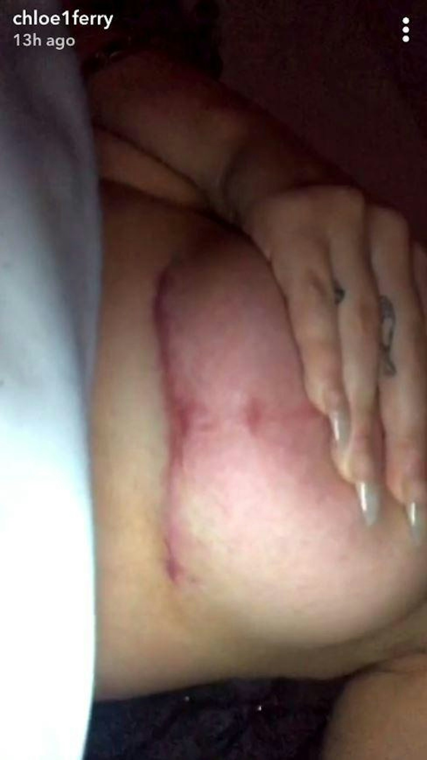 Chloe Ferry boob surgery scar