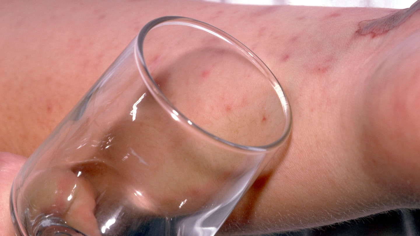 meningitis rash glass test