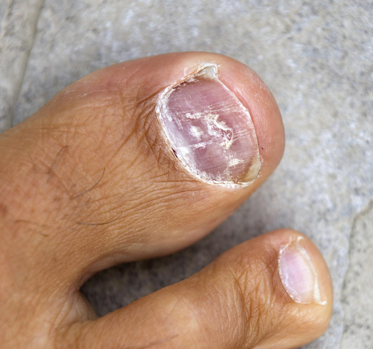 PDF) Fungal nail infections
