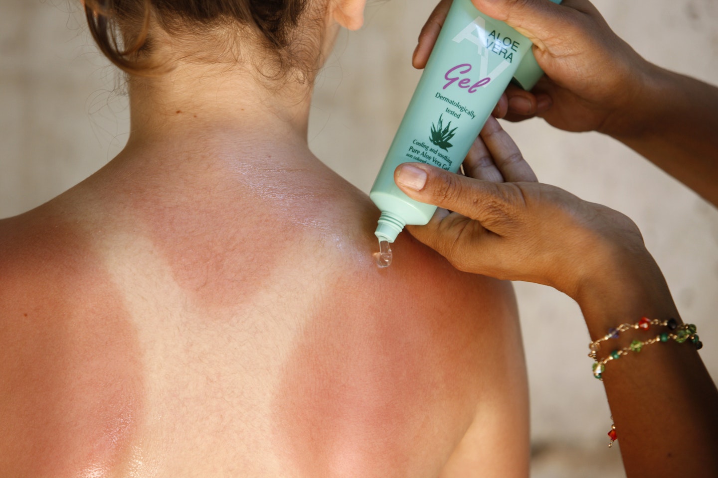 home remedies sunburn