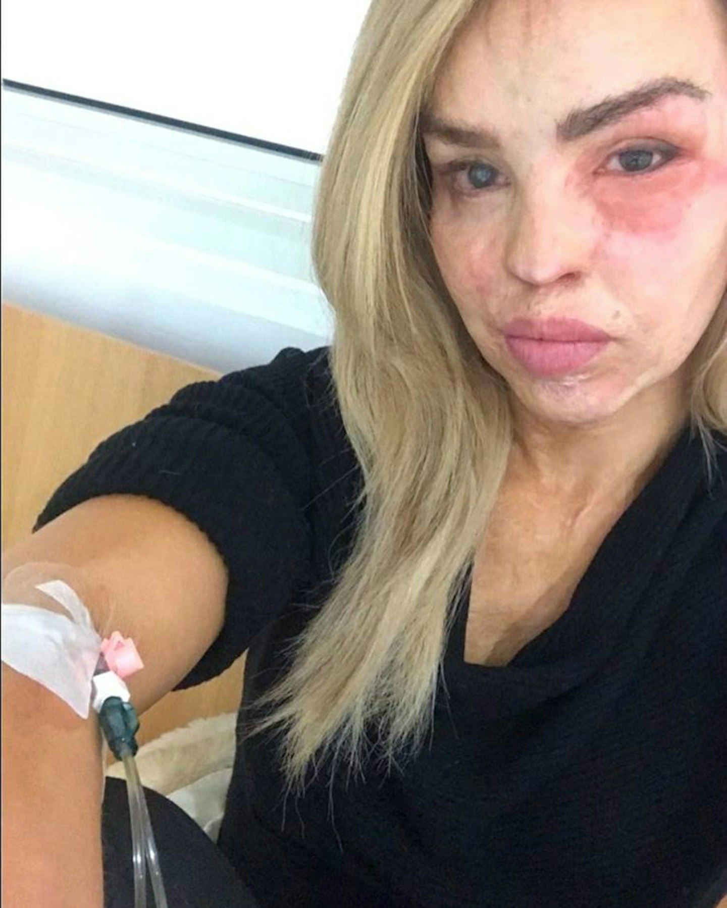 katie-piper-hospital-daughter-belle-birthday-severe-eye-infection-richard-sutton