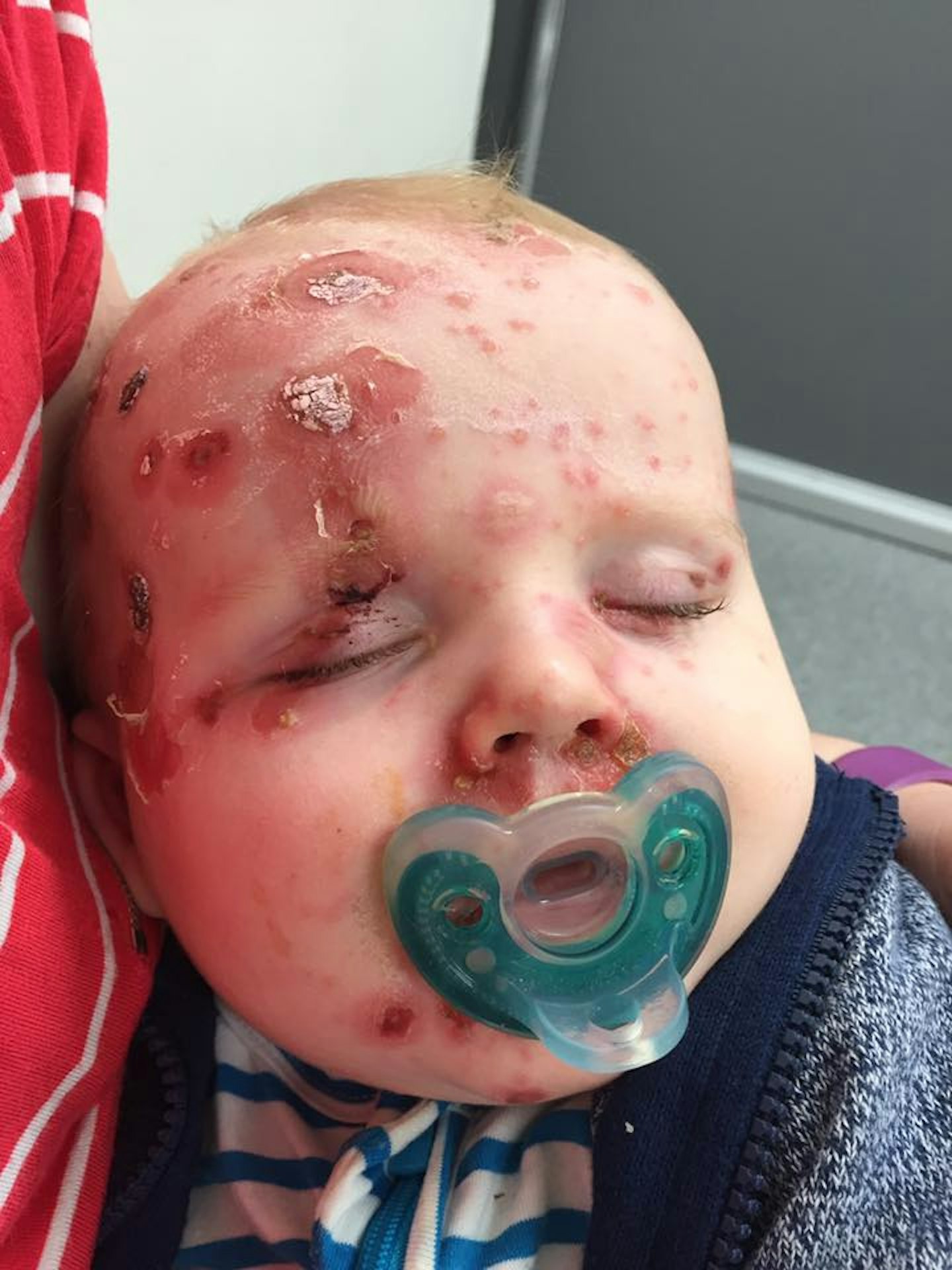 Child with extreme chickenpox