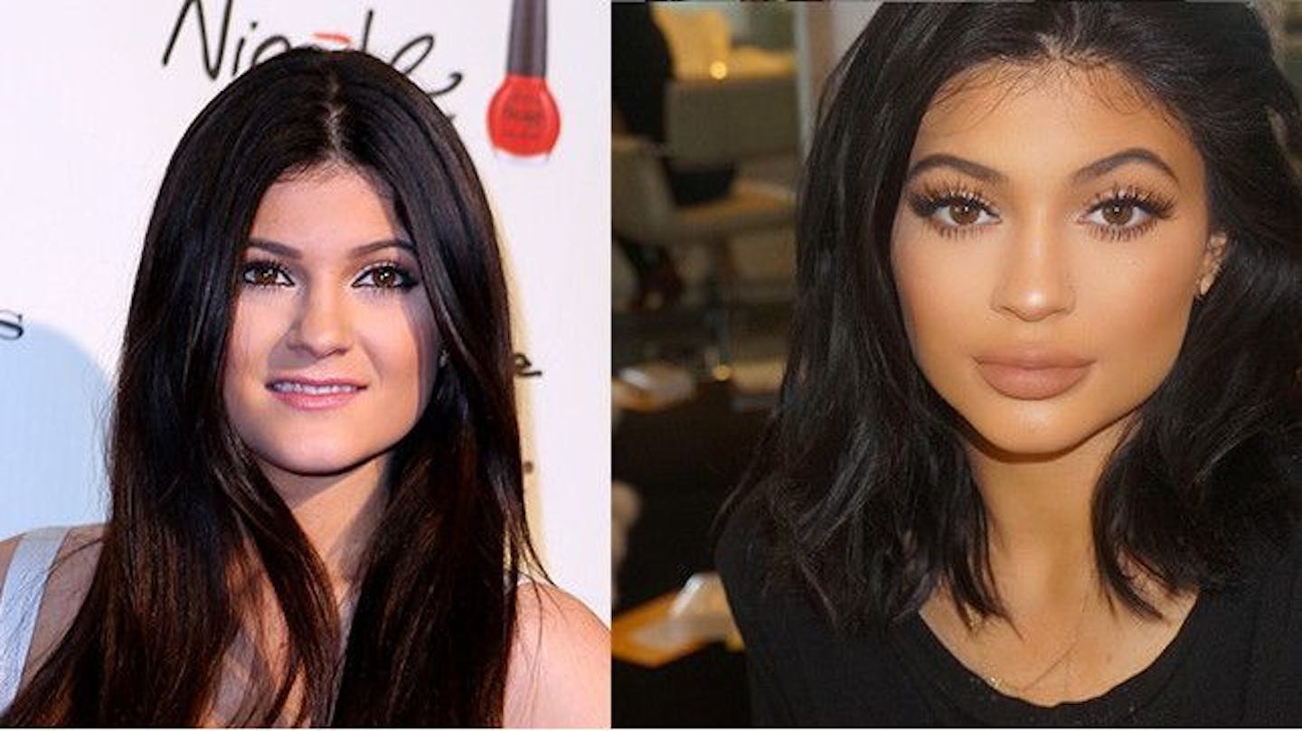 Kylie Jenner Before And After Her Jaw dropping Transformation Pics Kylie Jenner Before And After Her Jaw dropping Transformation Pics