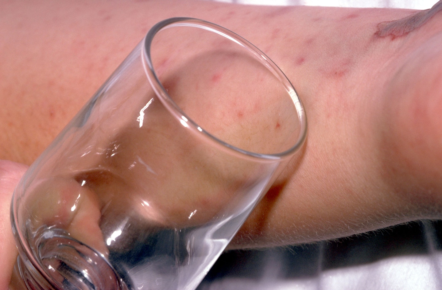 meningitis rash glass test