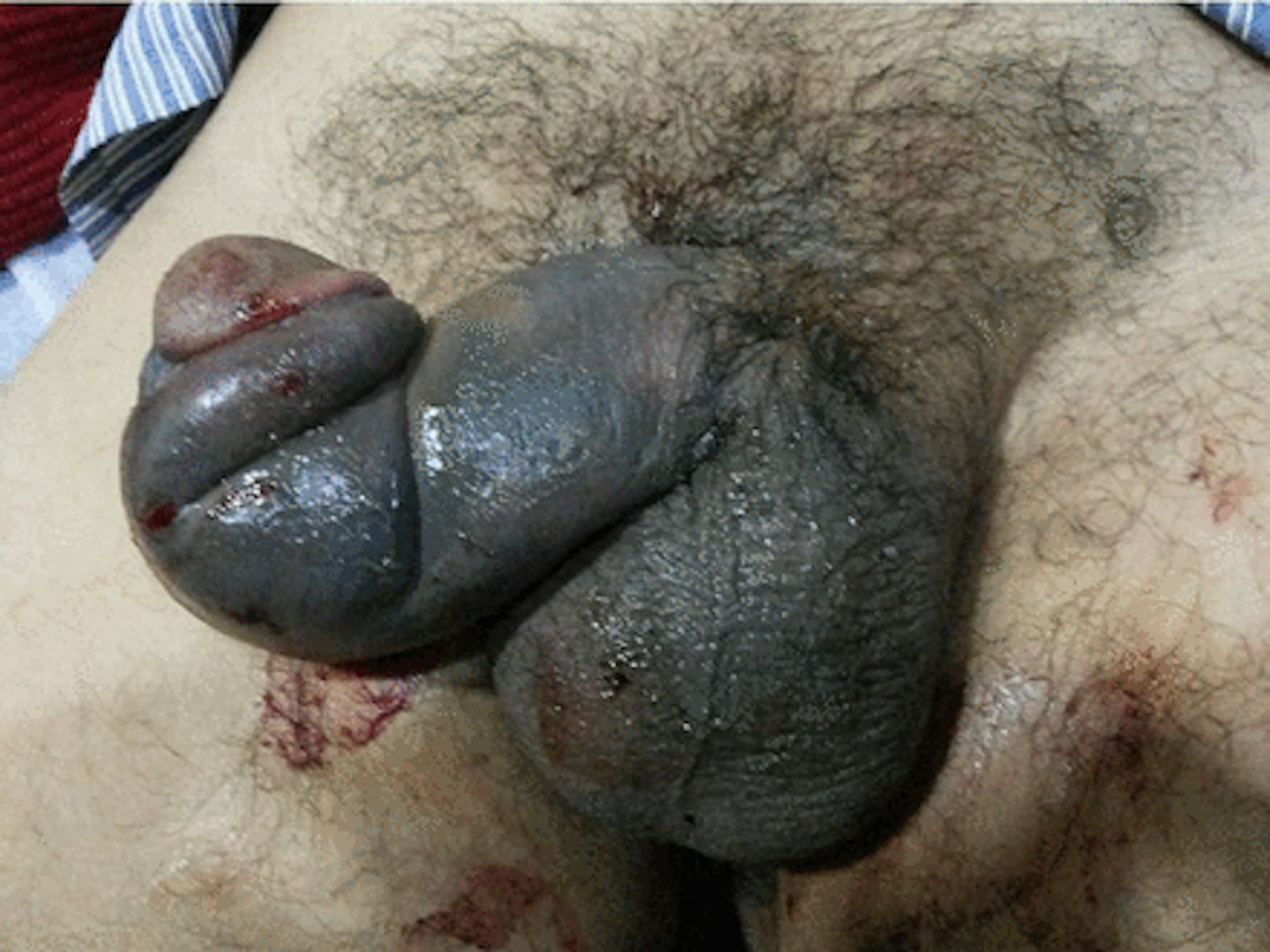 penile fracture