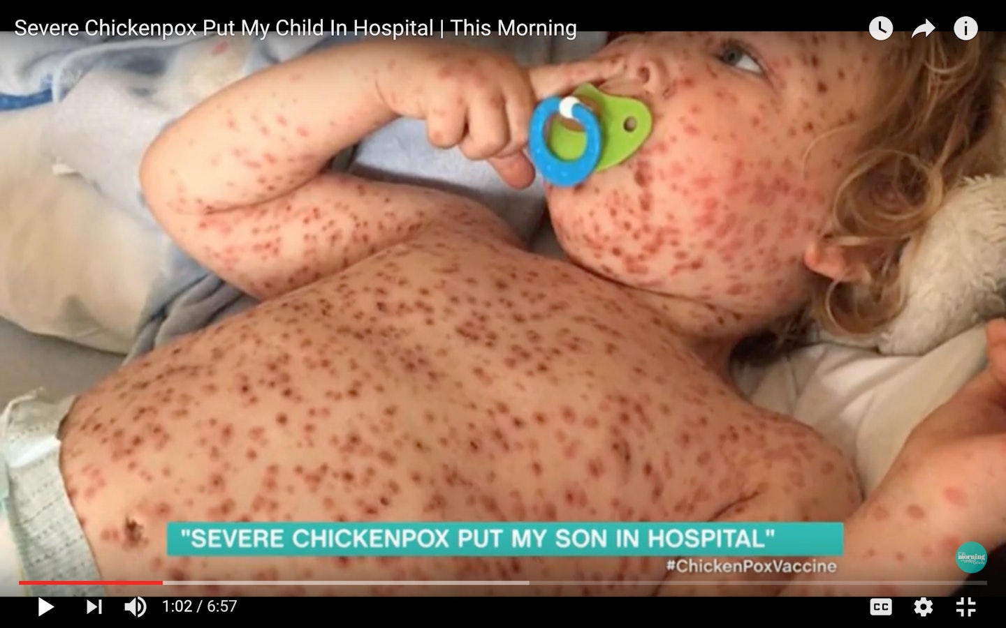 chicken pox Jaspar Allen This Morning 