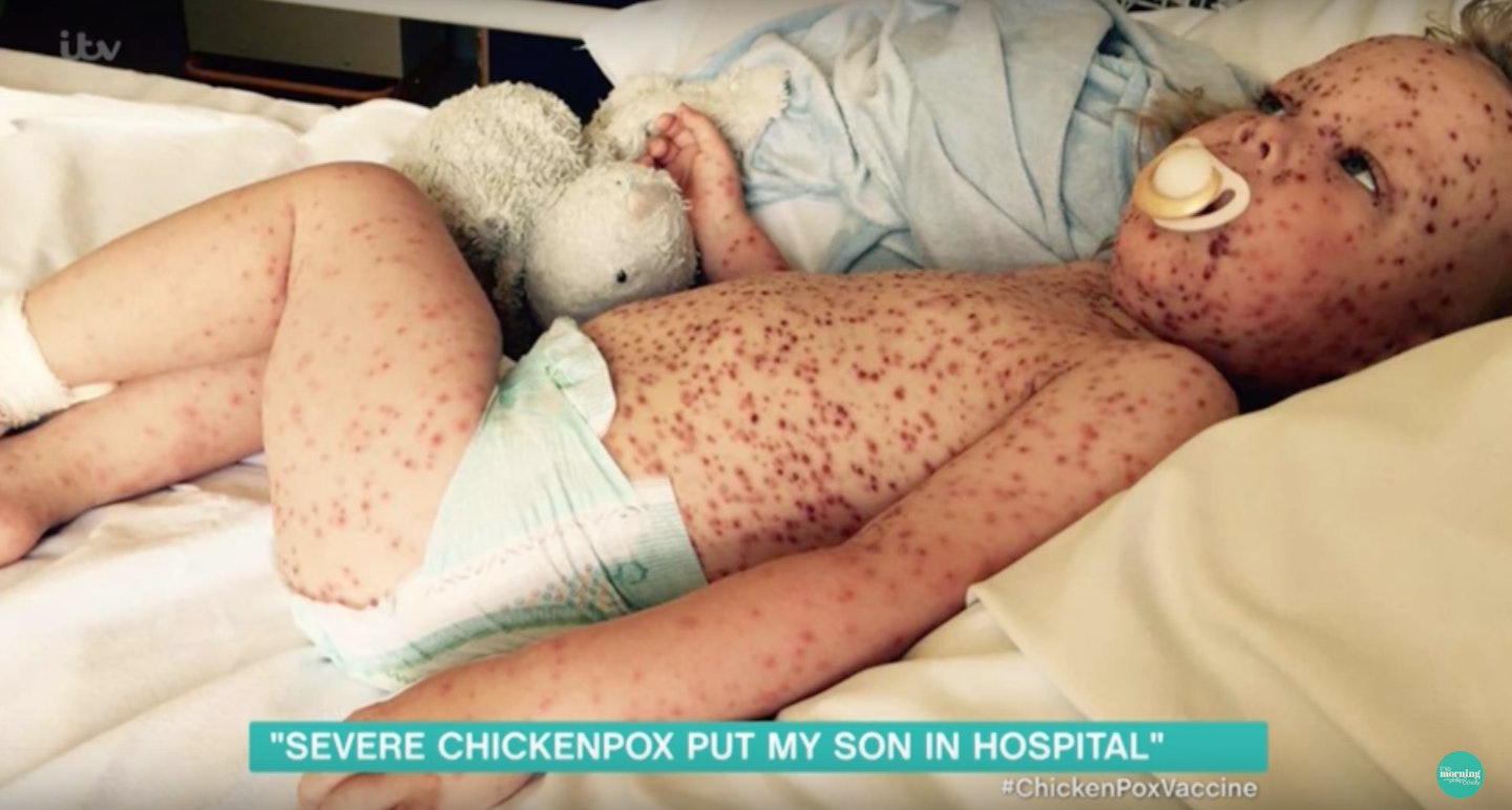 chicken pox Jaspar Allen This Morning 