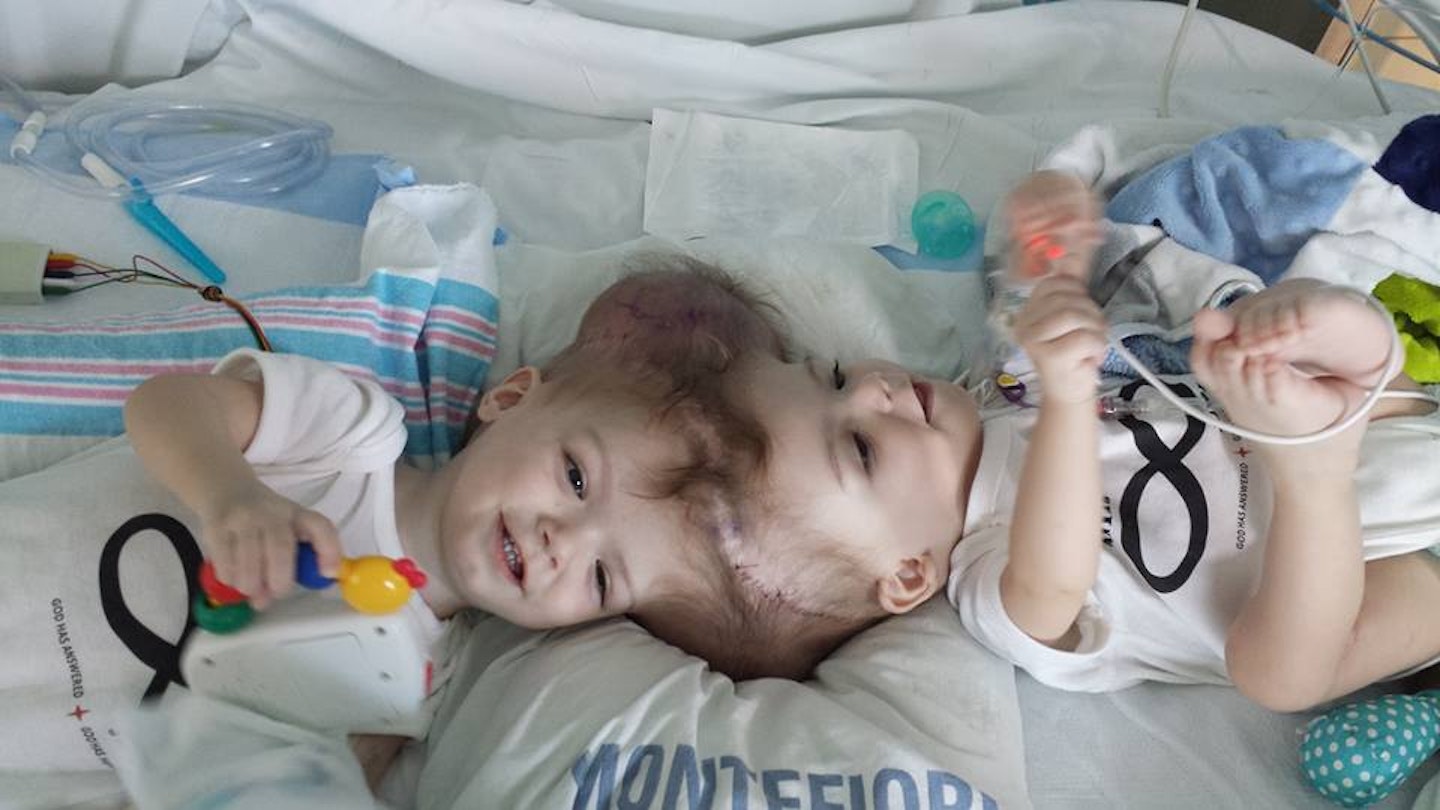 Twin boys conjoined Jadon and Anais