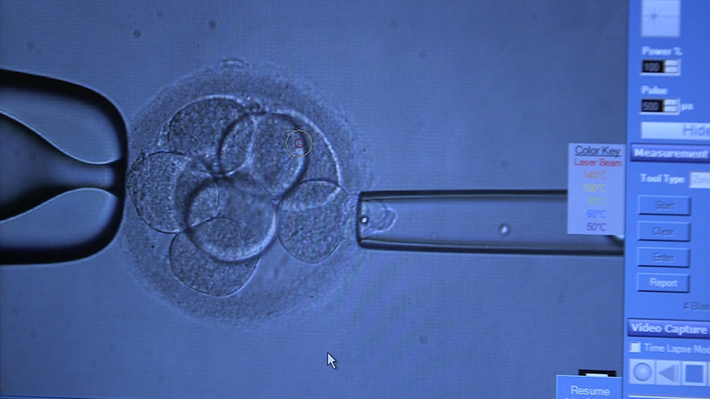 Fertility treatments IVF bolt 