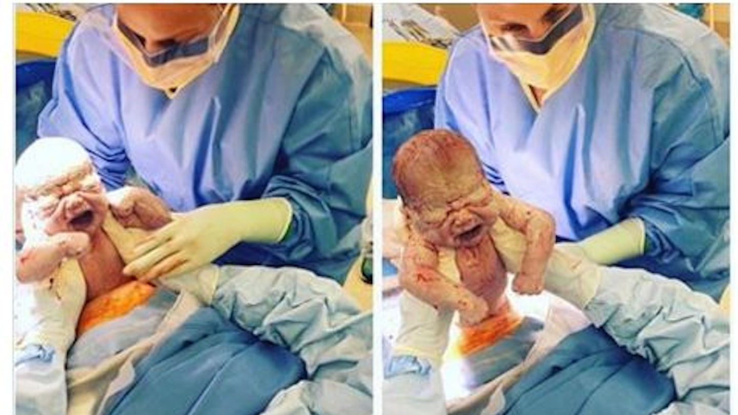 Maternal assisted c-section