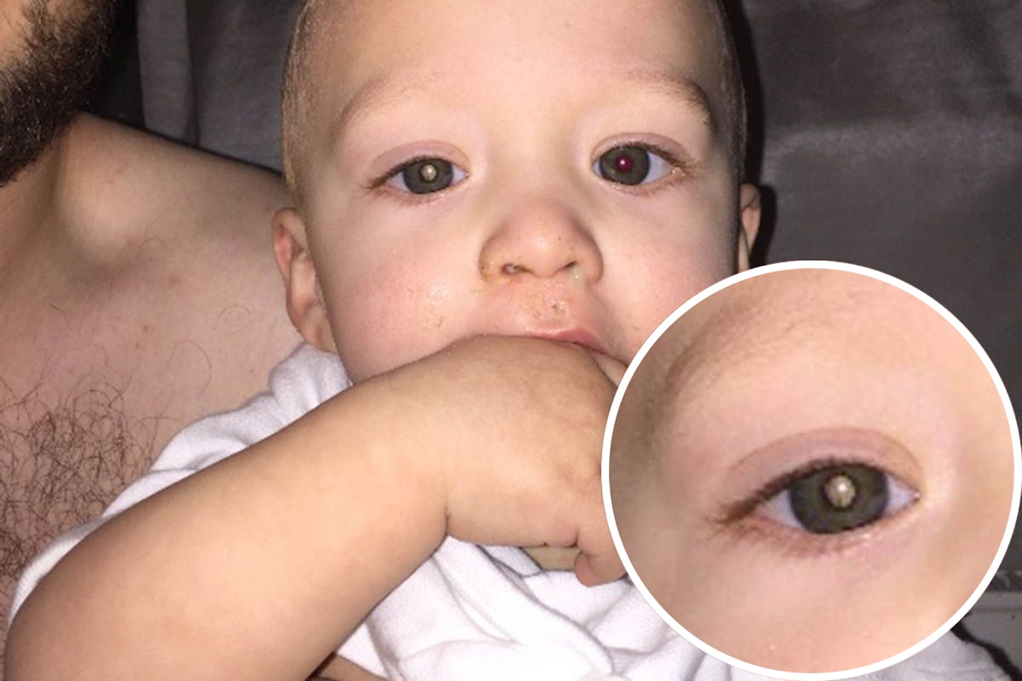 baby-cancer-eye-photo-owen-scrivens-jaxson-emily-smith