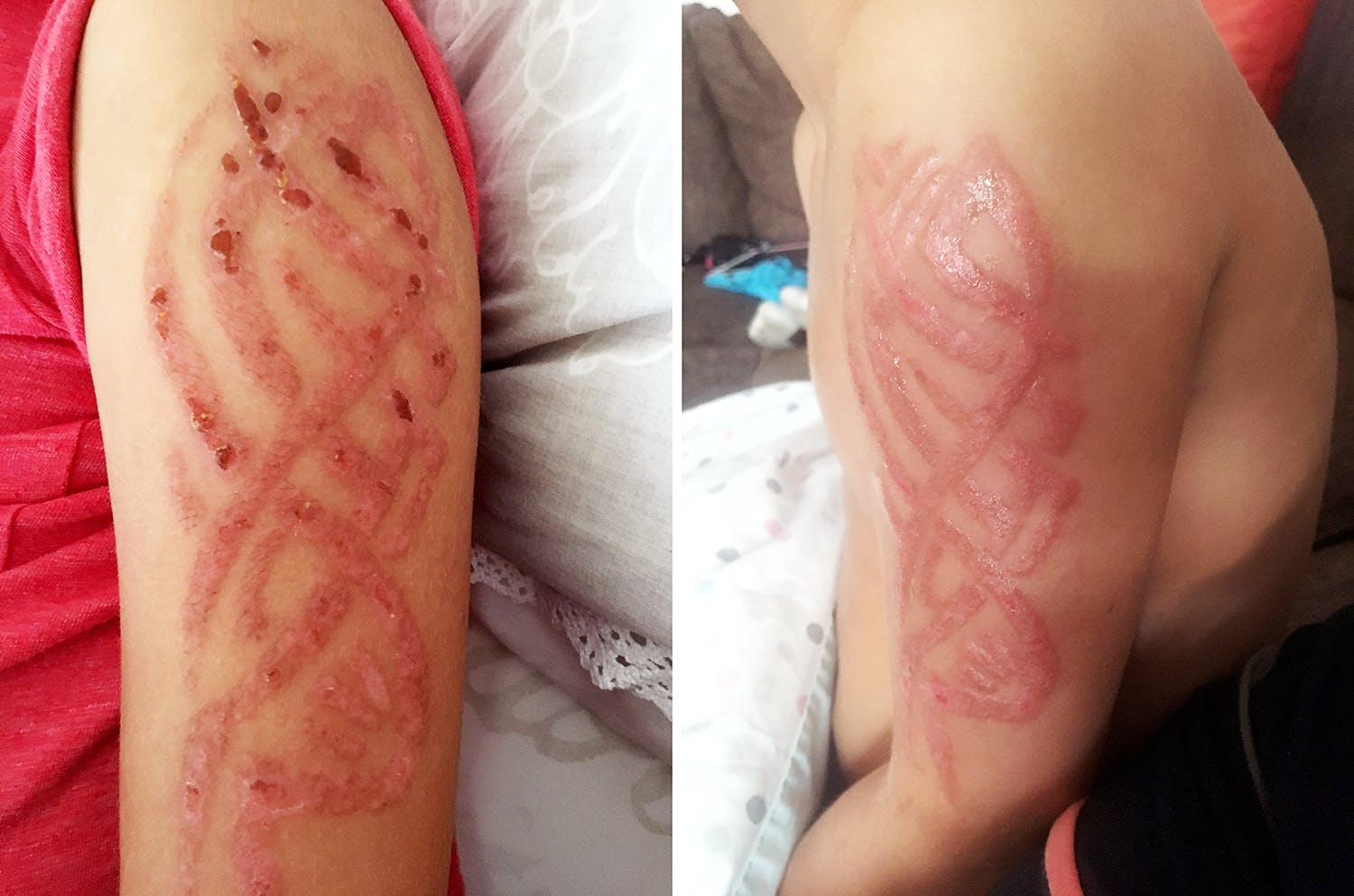 Tattoos and Delayed Allergic Reactions - The Waiting Room