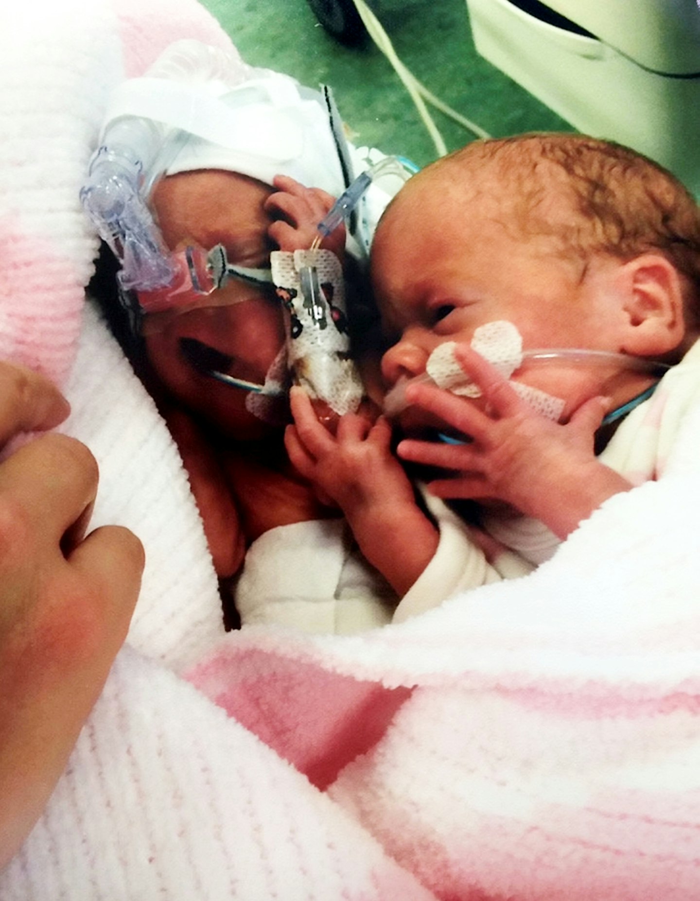 Premature twins Grace and Olivia Oman