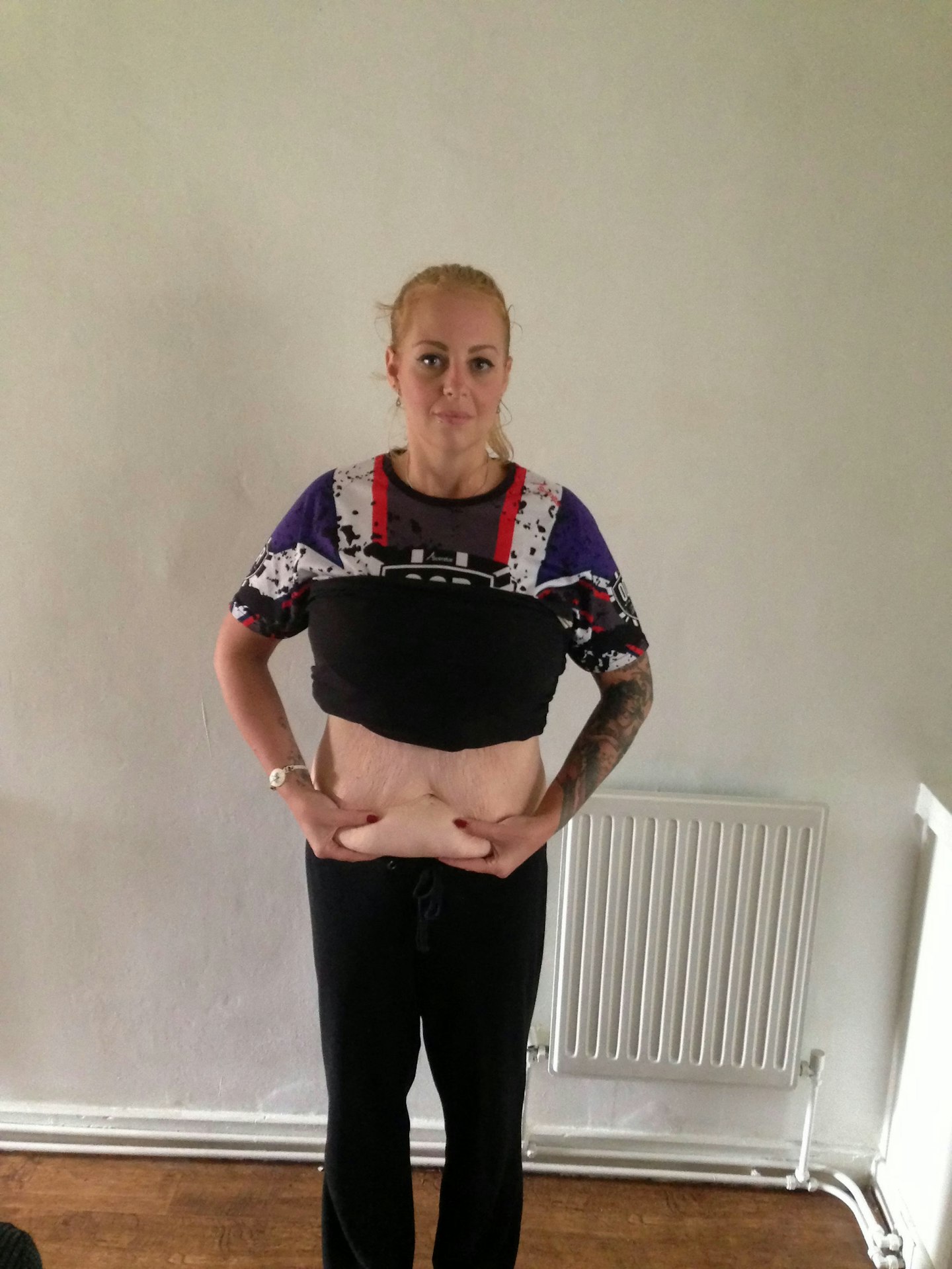 tummy tuck