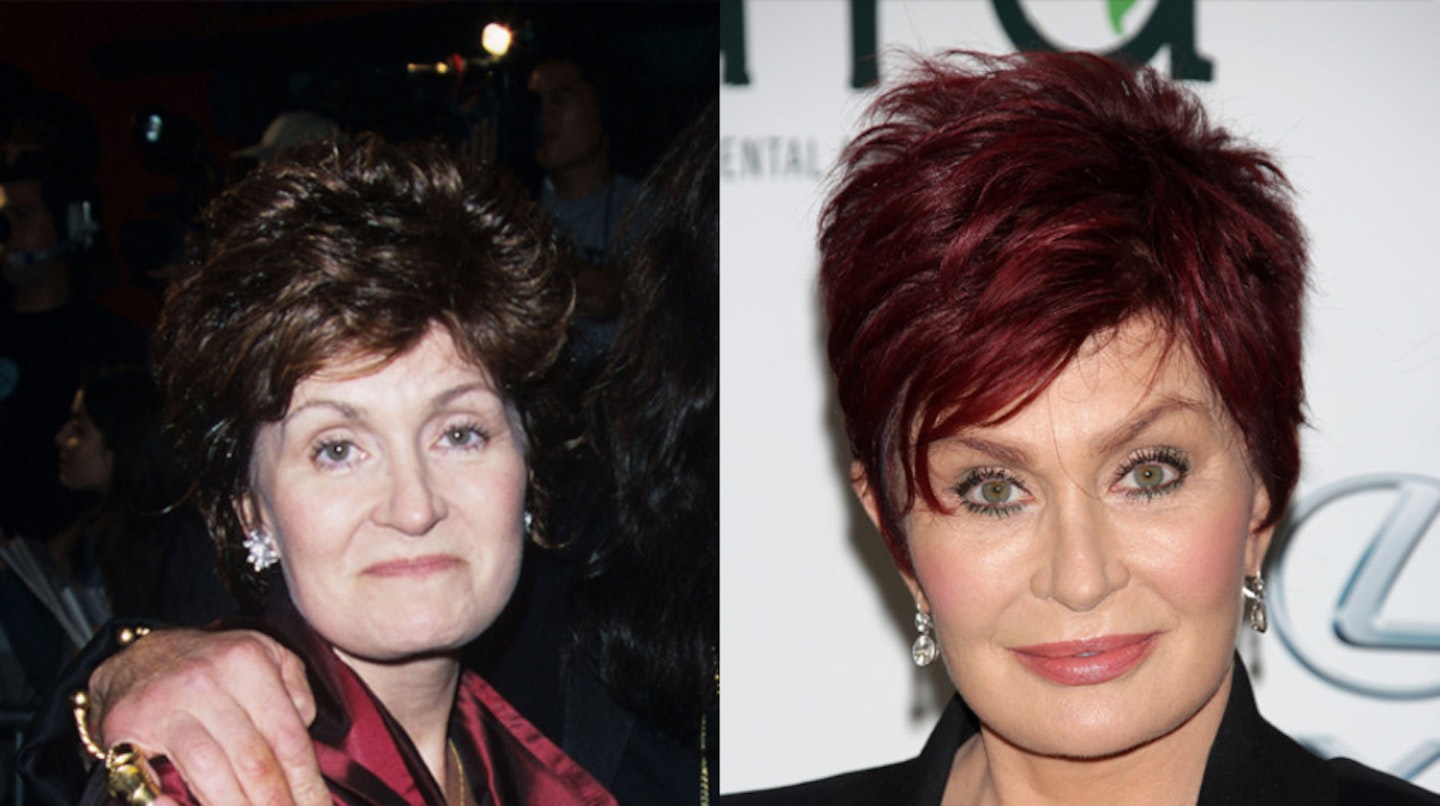 sharon-osbourne-before-after-surgery