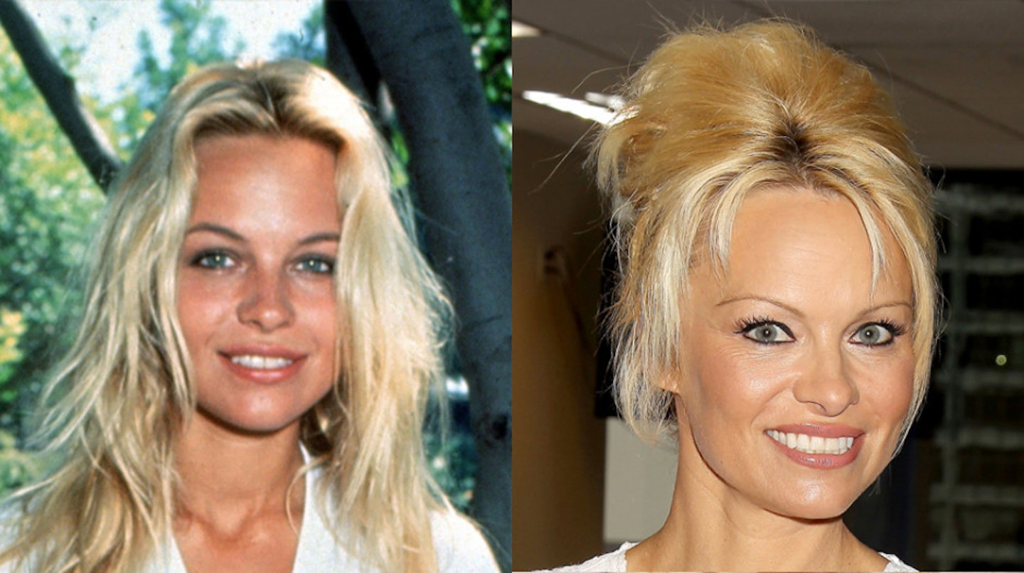 pamela-anderson-before-after-surgery