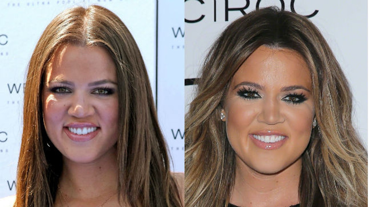 khloe kardashian before and after surgery face