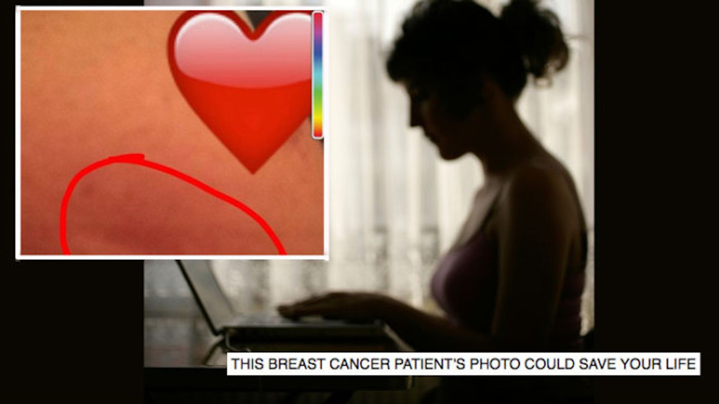 Woman shares breast picture that revealed she had cancer: \