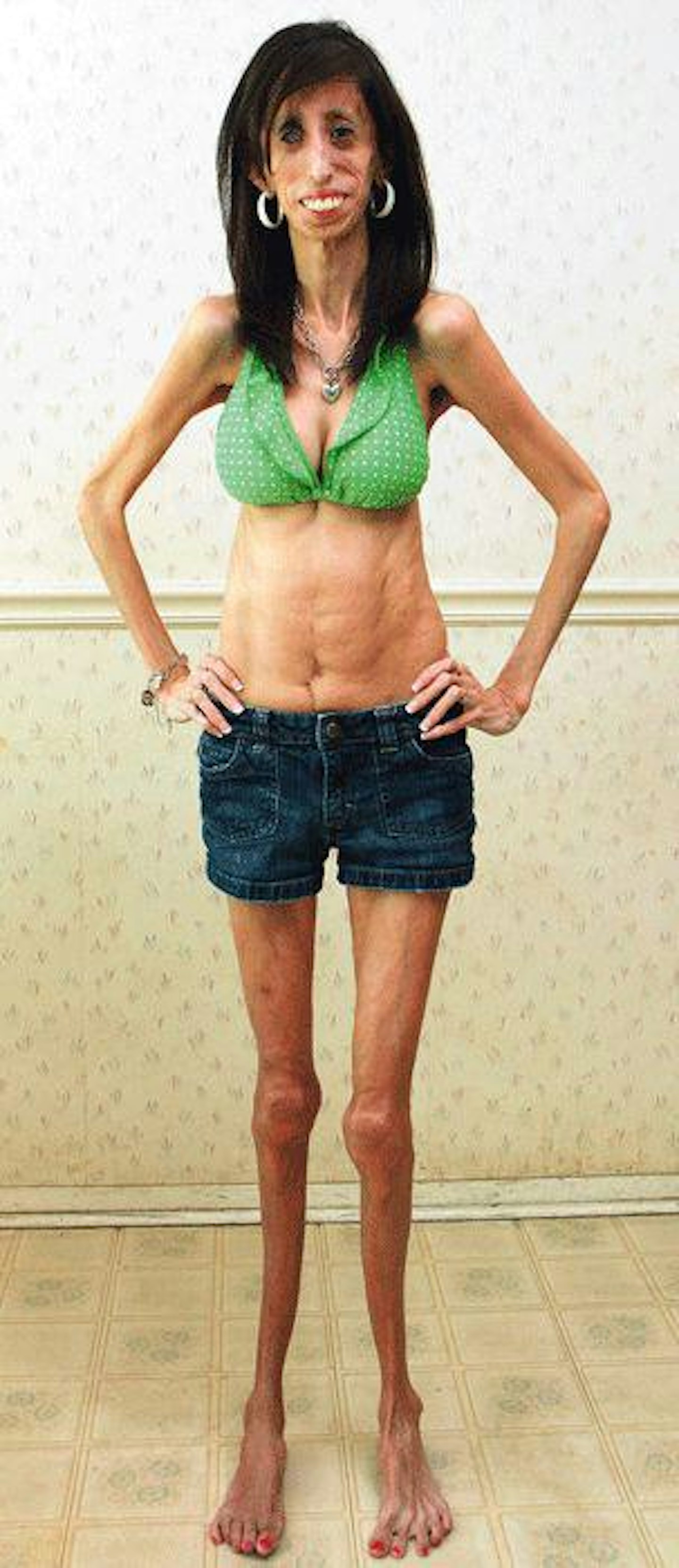Lizzie Velasquez