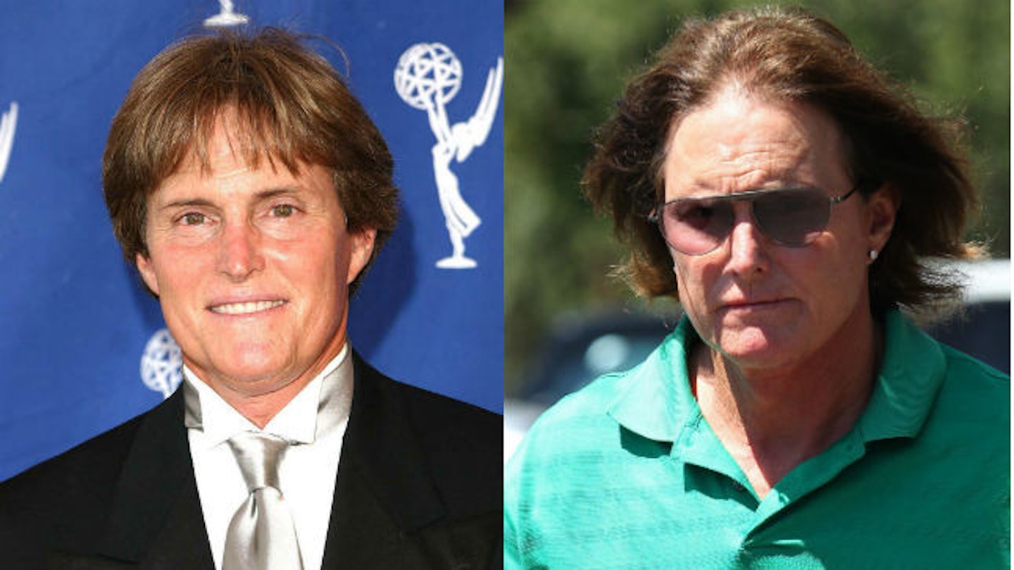 bruce jenner surgery before and after
