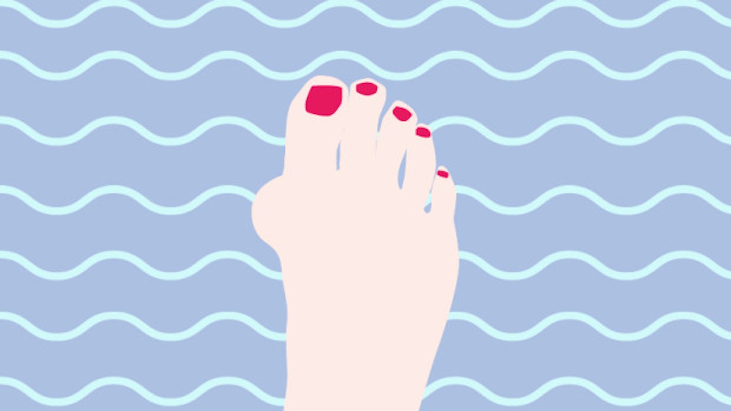 Bunions. What They Are And How To Make Them F*ck Off