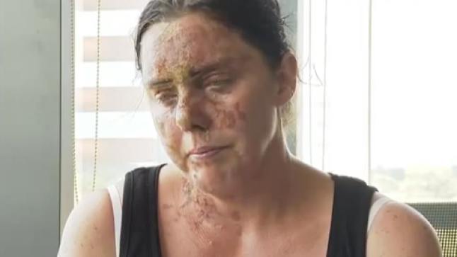 Southampton acid attack victim bravely shows injuries on TV: ‘Feels ...