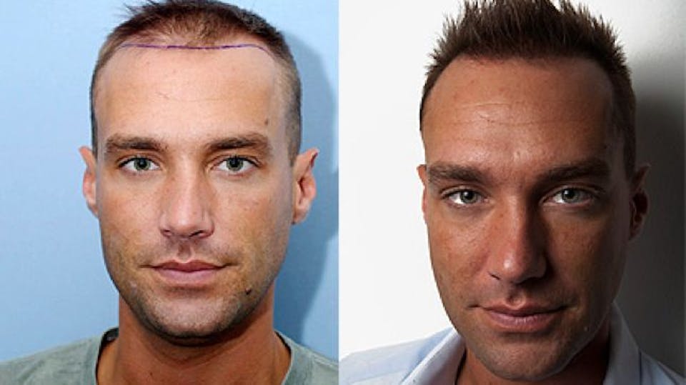 Calum Best follows in the footsteps of Wayne Rooney and Gordon Ramsay with  a hair transplant | Closer