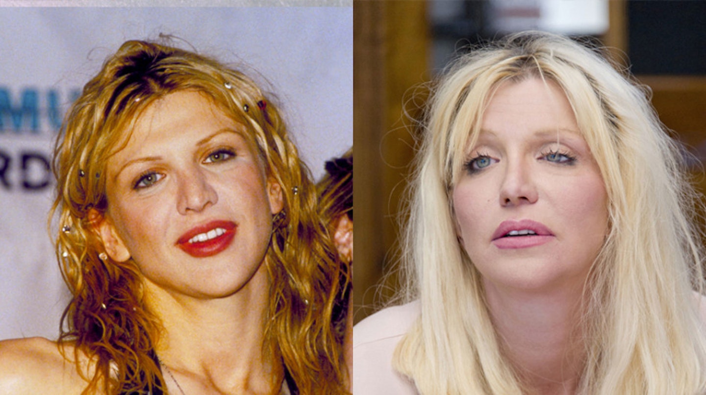 courtney-love-before-after-surgery