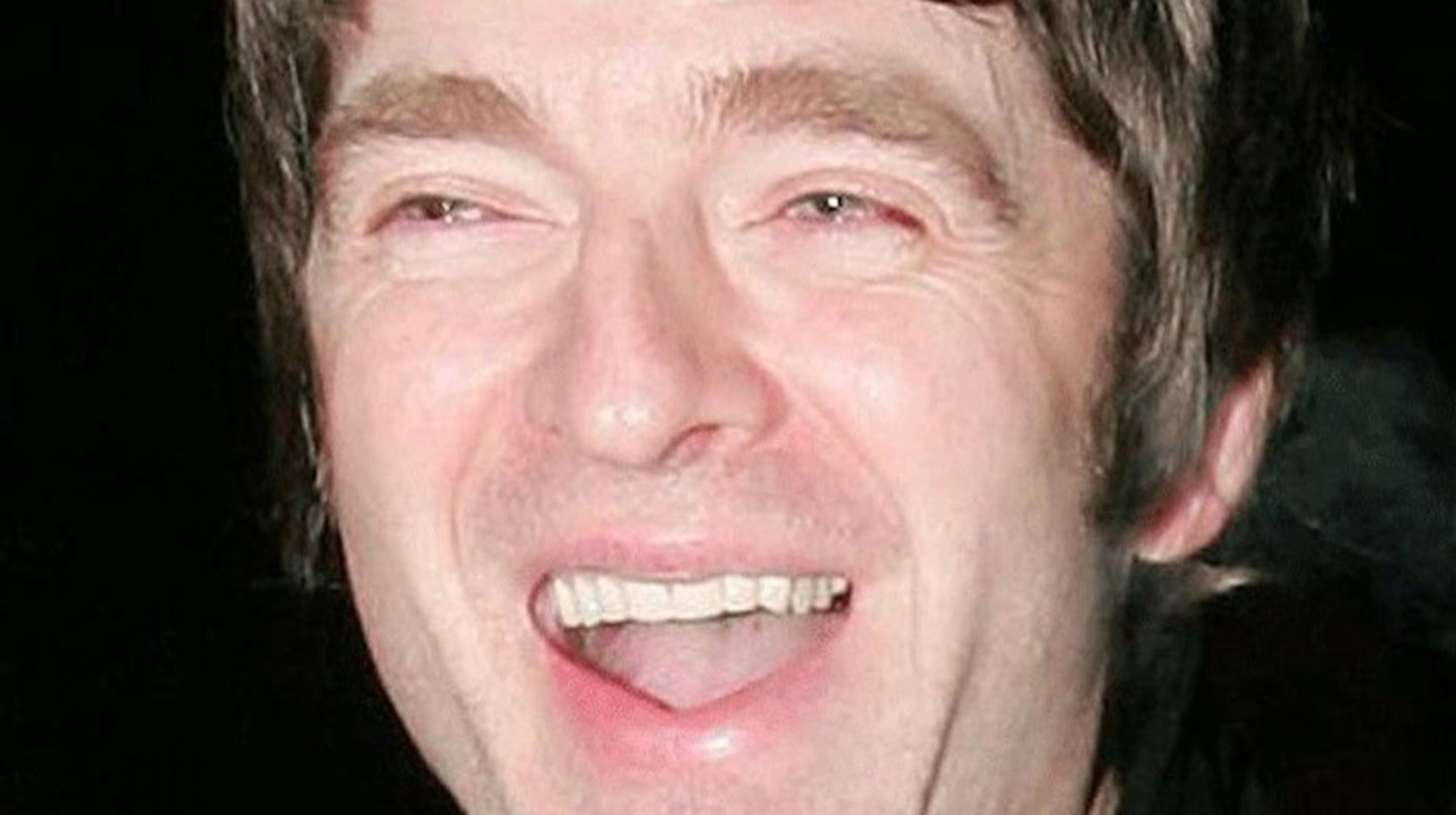 Noel-Gallagher-Oasis-teeth-after