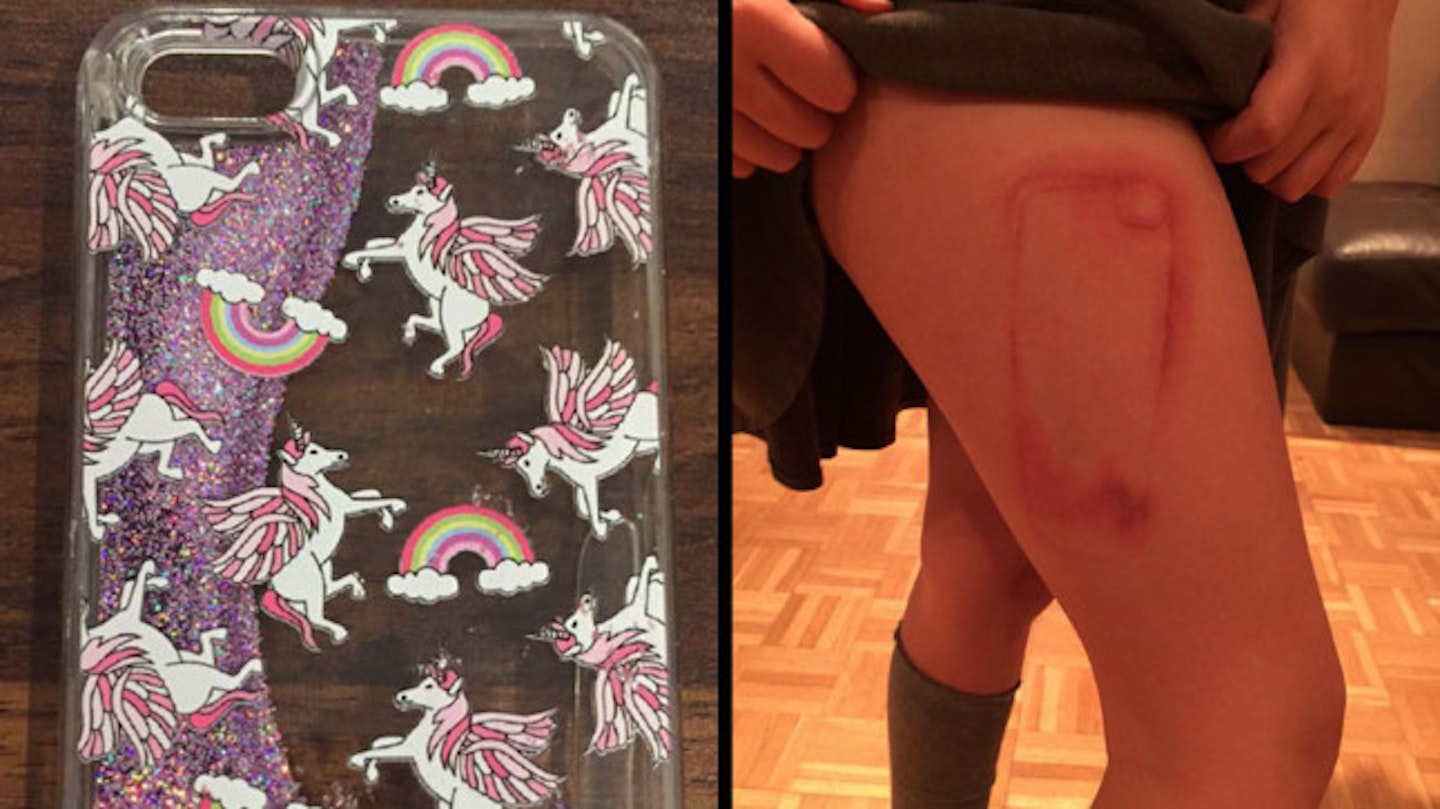 Mum posts Facebook warning after daughter burned by iPhone case: ‘She’s scarred for life’