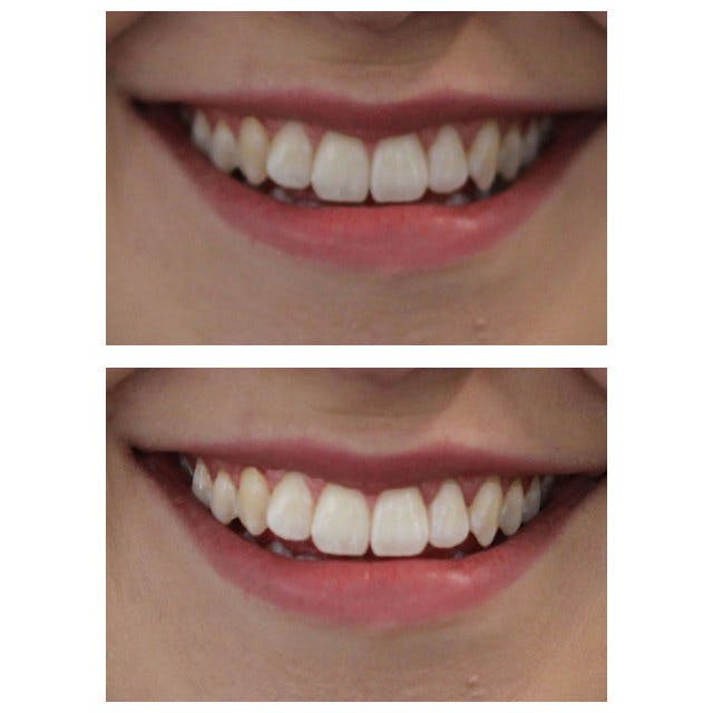 black diamond toothpaste before and after