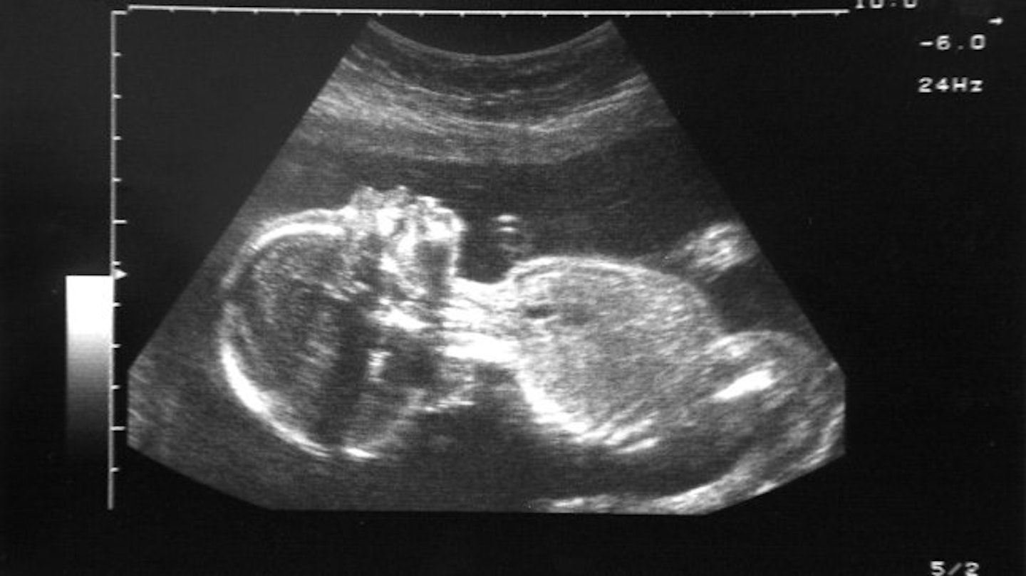 The 13-year-old shared her baby scan on Facebook