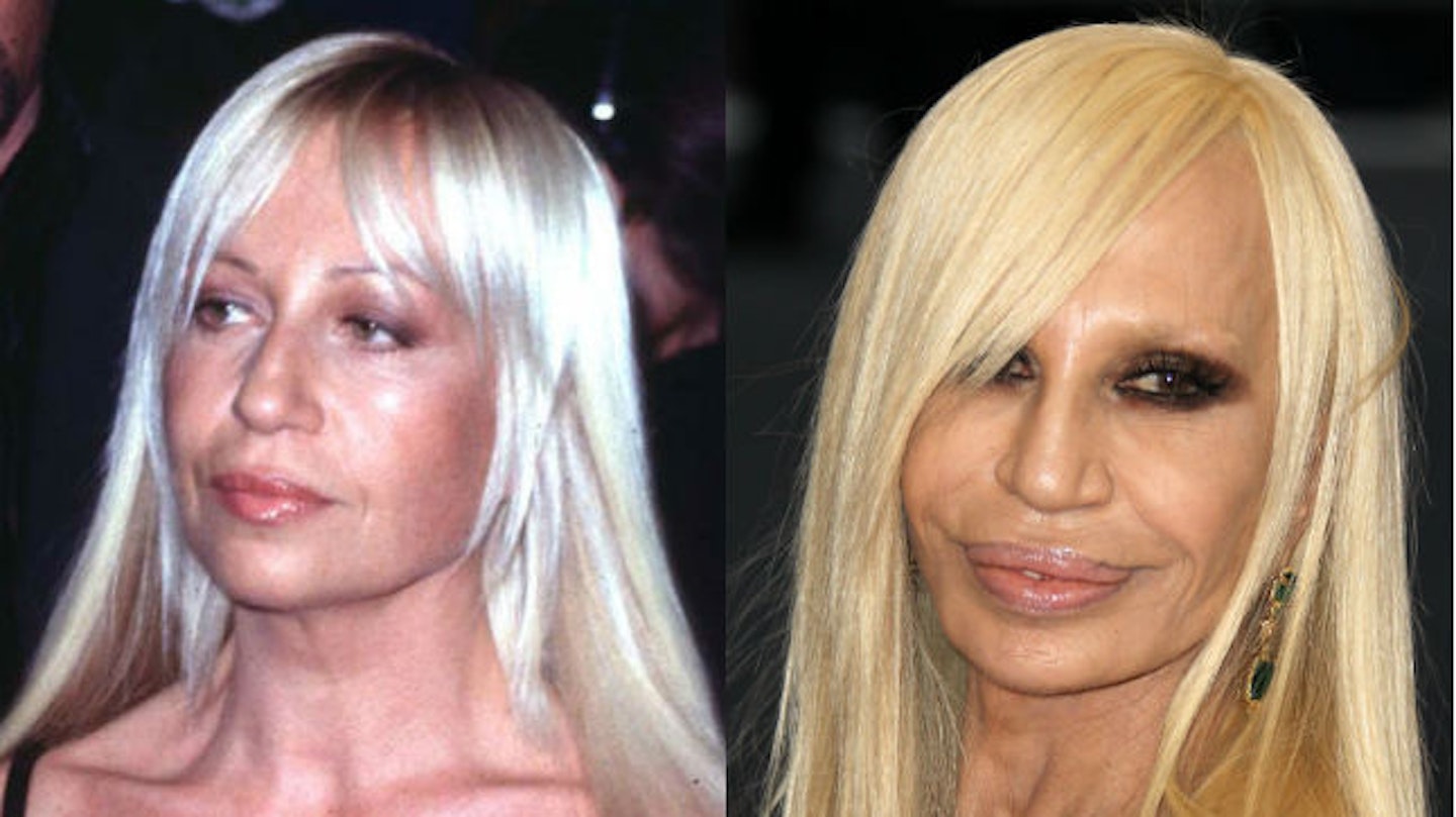donatella versace before and after surgery