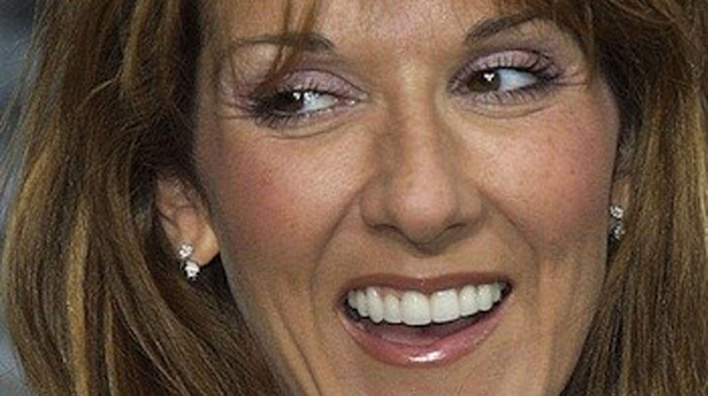 Celine-Dion-after-surgery-teeth