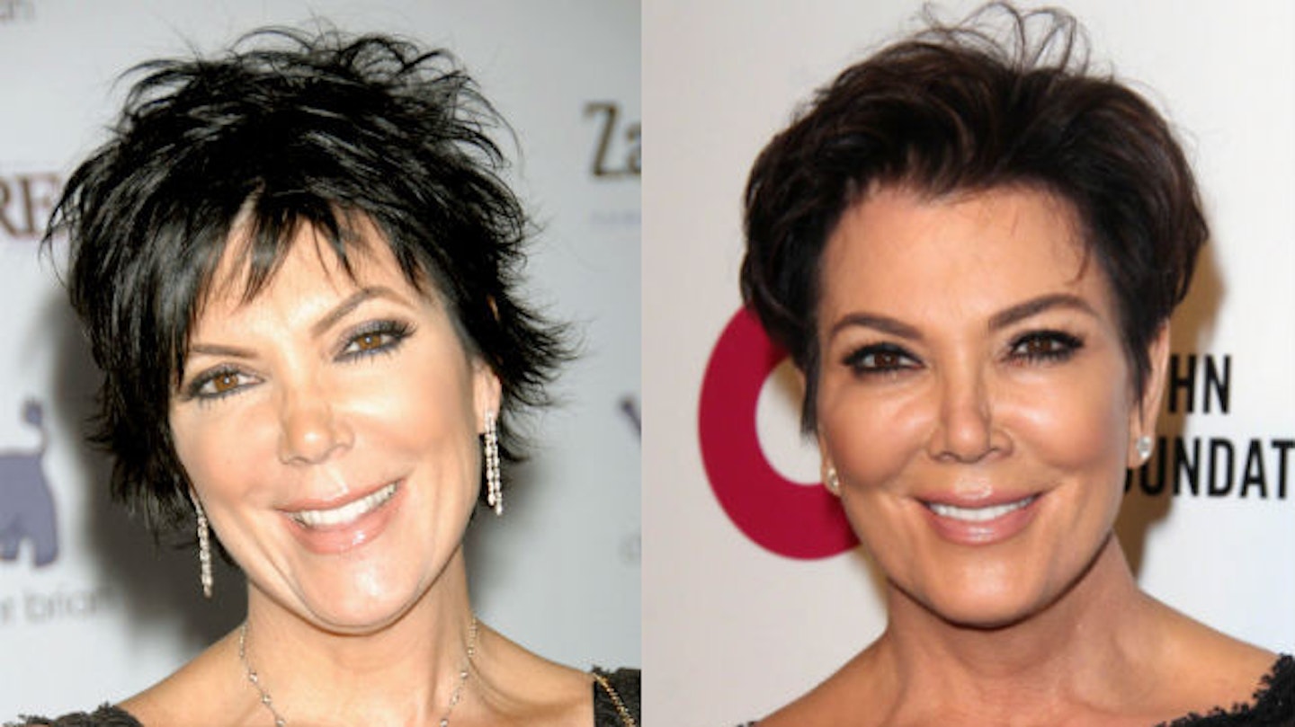 kris jenner before and after surgery face