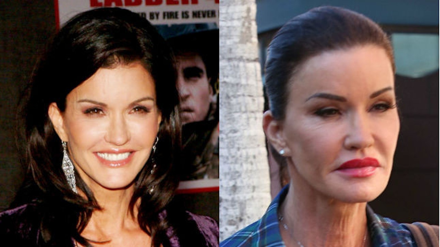 janice dickinson before and after surgery