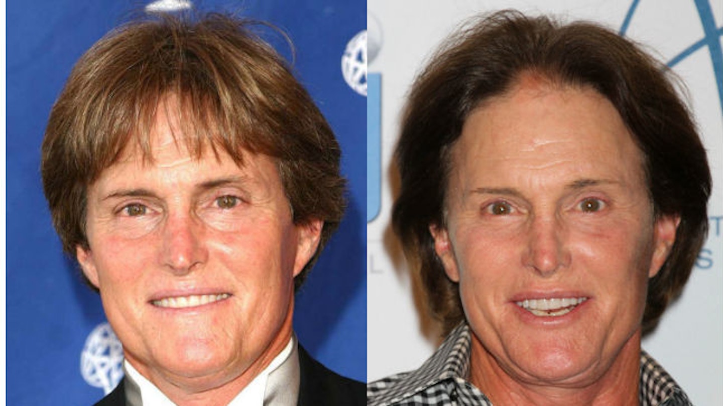 Bruce Jenner before and after surgery