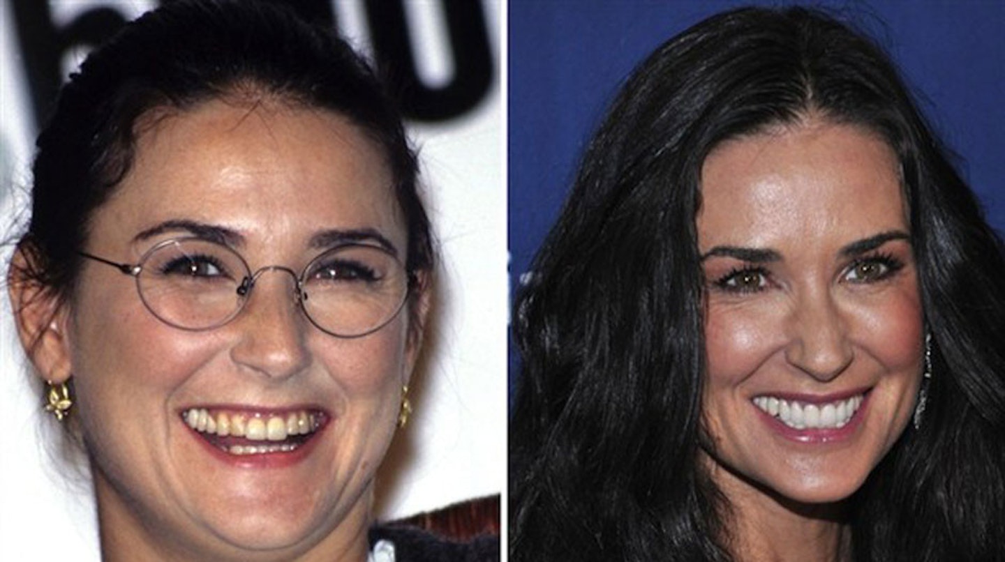 Demi-Moore-before-after-surgery