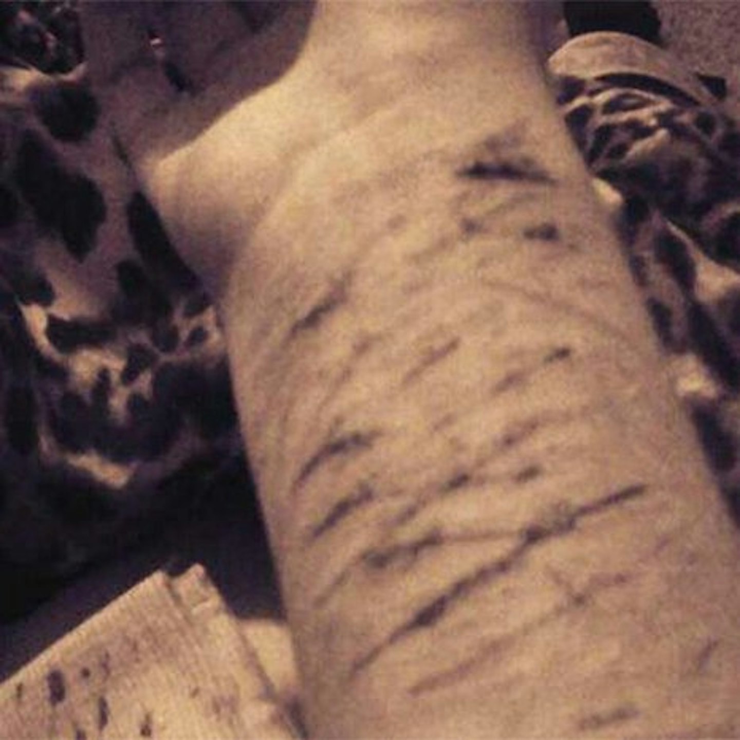 A shocking picture of self-harm on Instagram