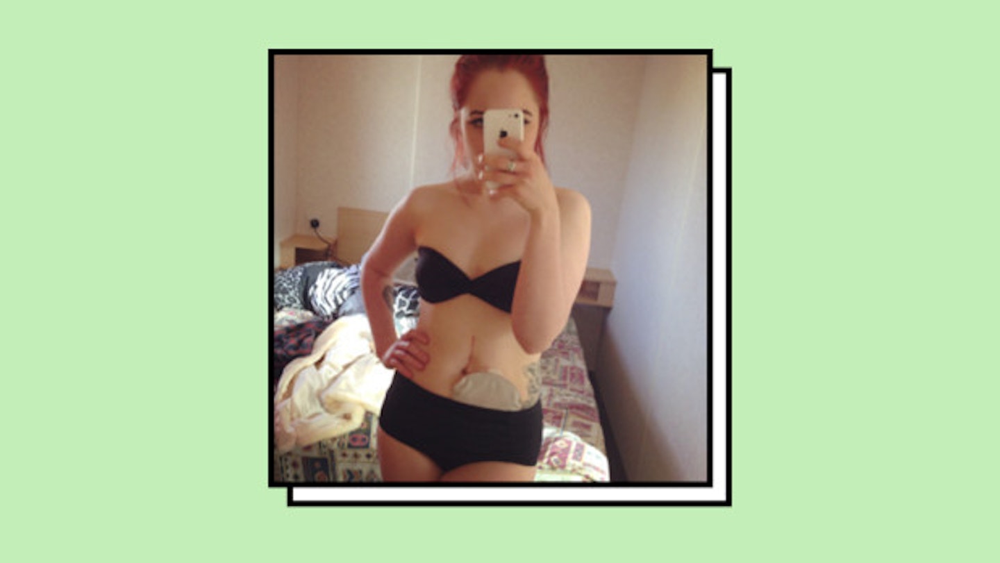 11 Things You Only Know When You Have An Ostomy In Your 20s