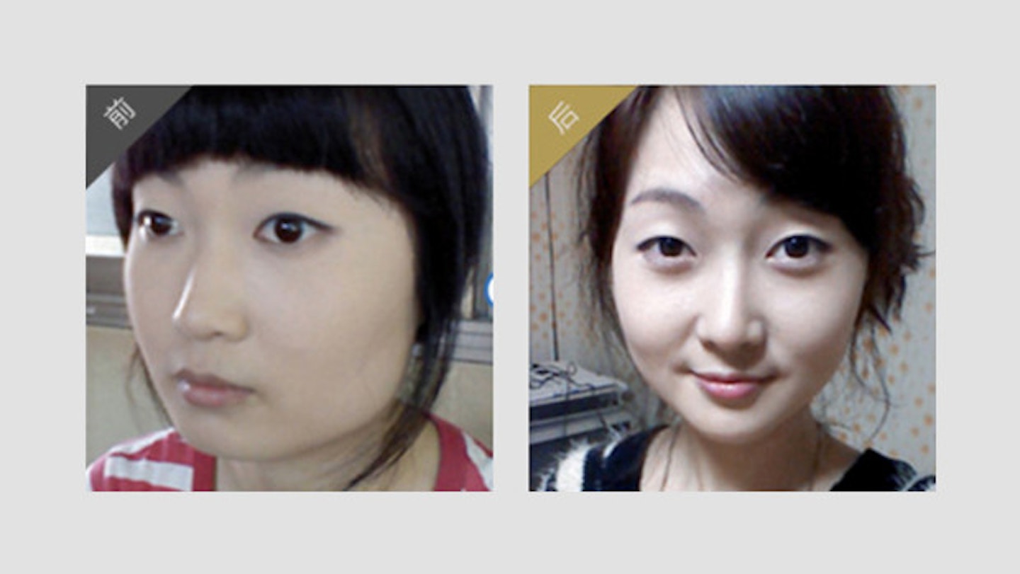 Before and after: eyelid, nose and face-slimming surgery