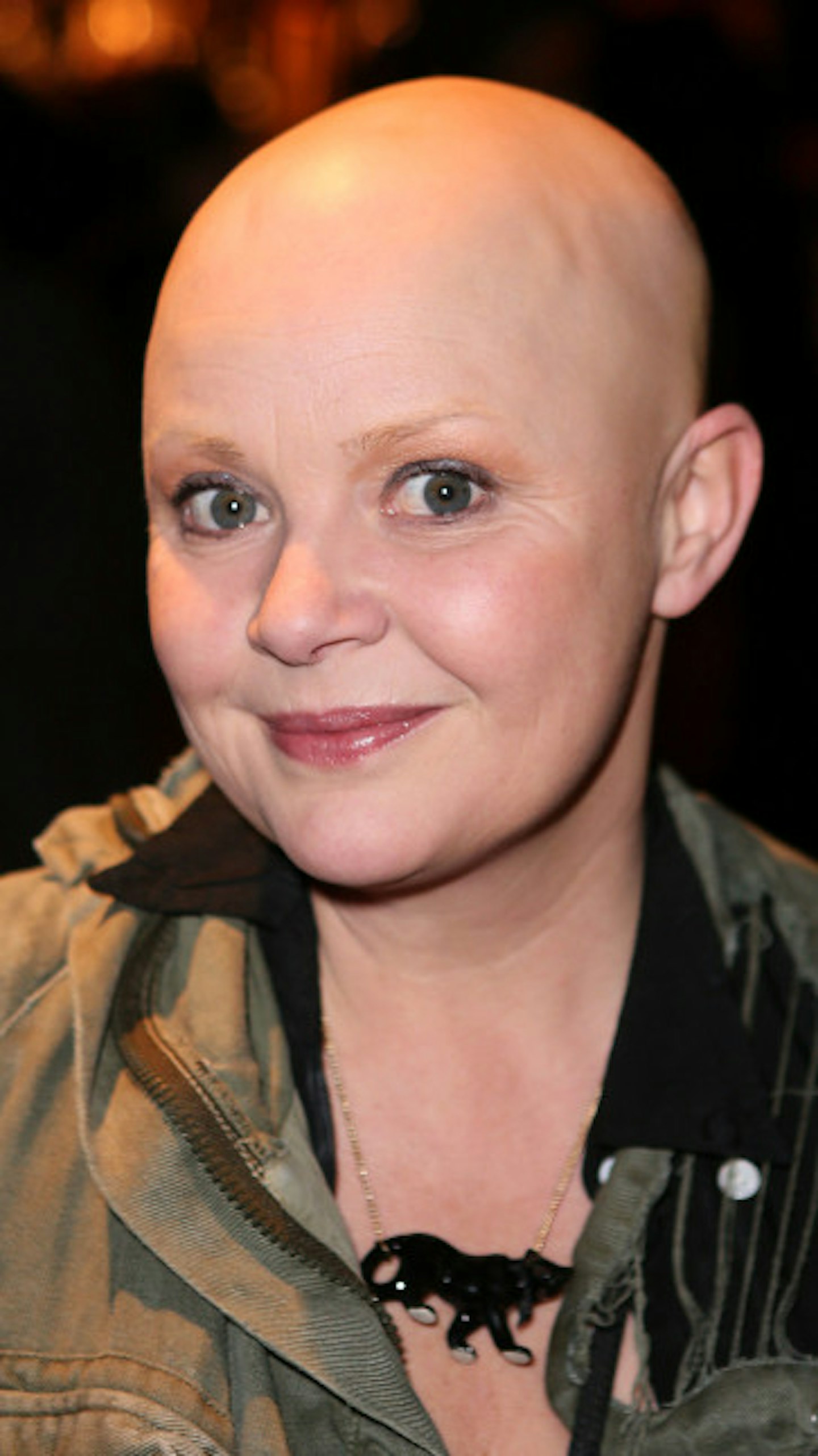 Gail Porter lost all of her hair to alopecia