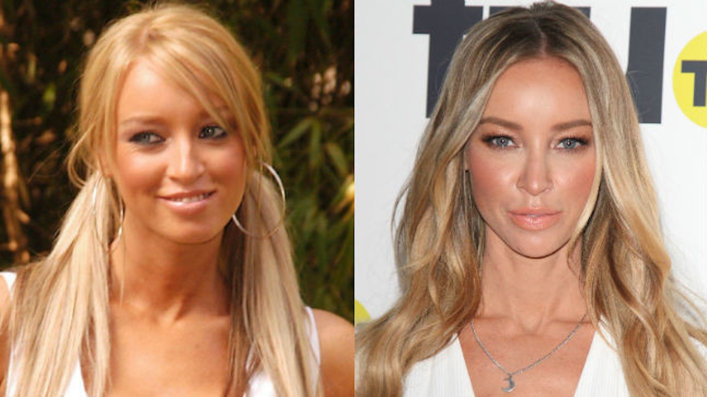 lauren pope before after surgery