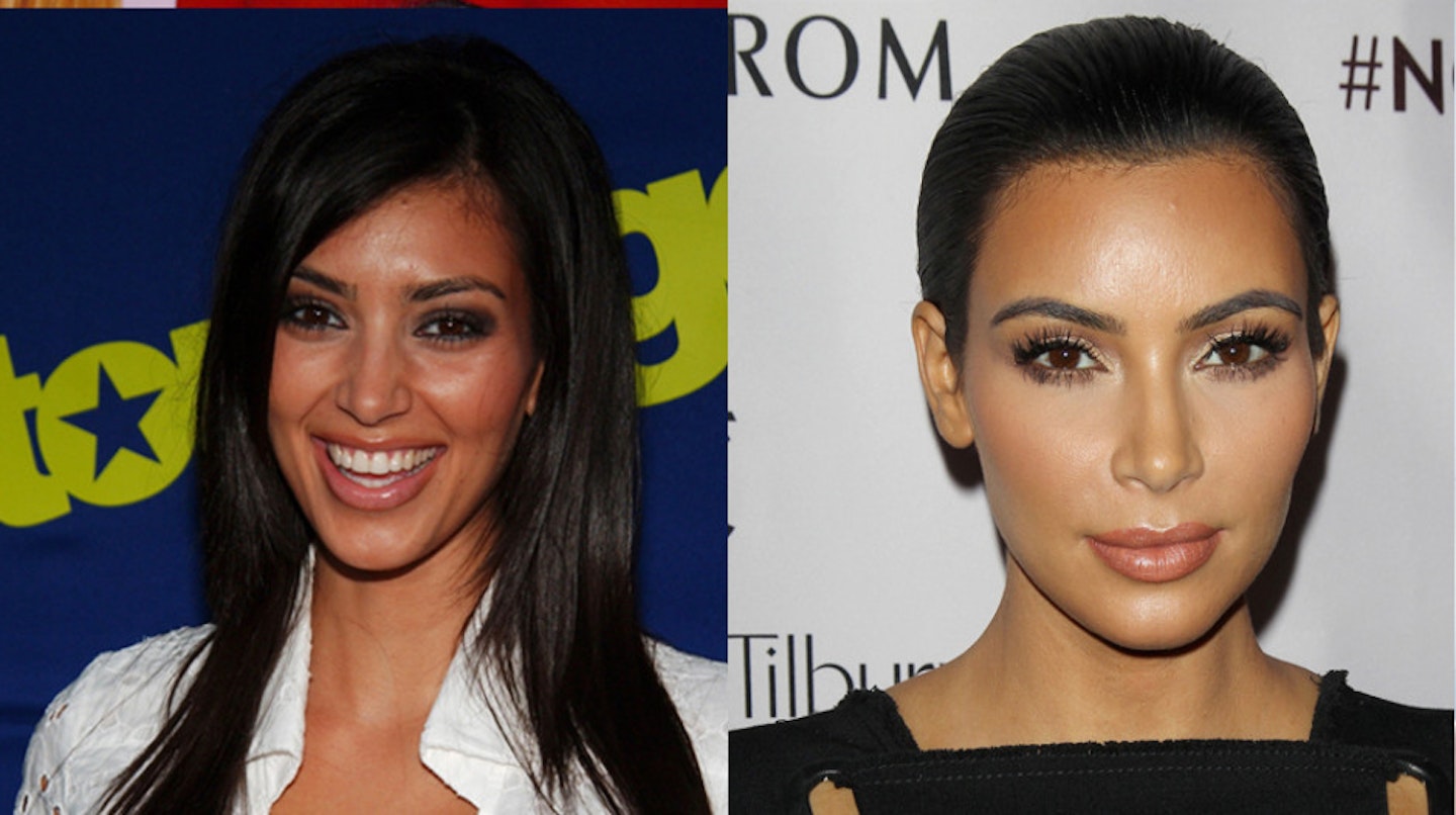 kim-kardashian-west-before-after-surgery