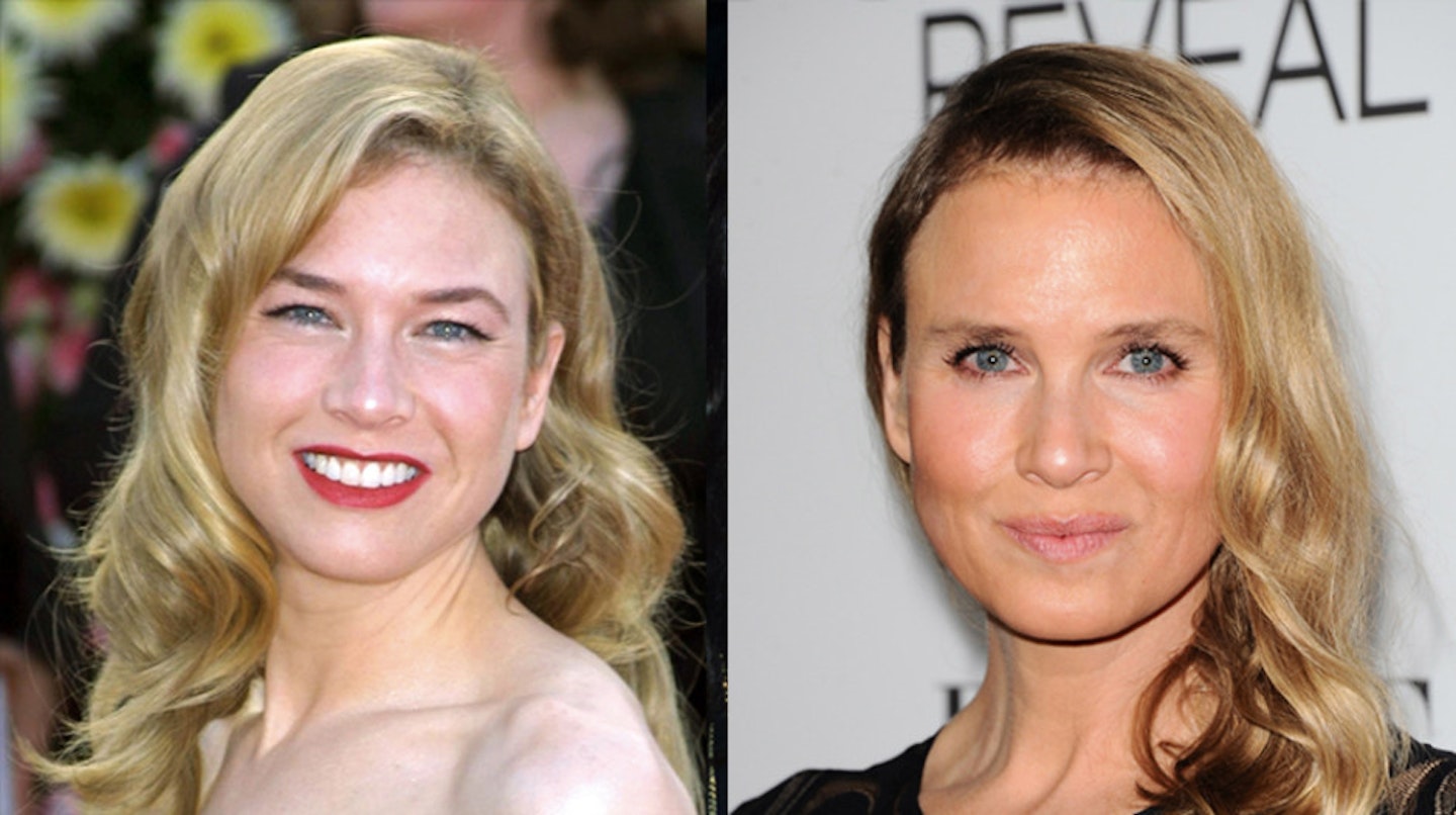 renee-zellweger-before-after-surgery