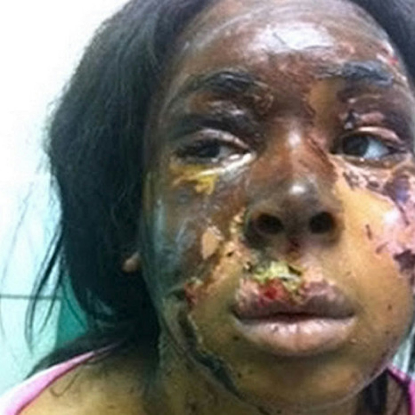 The acid left Naomi with horrific burns to her face, chest and neck